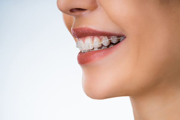 Proper Care For Clear Braces