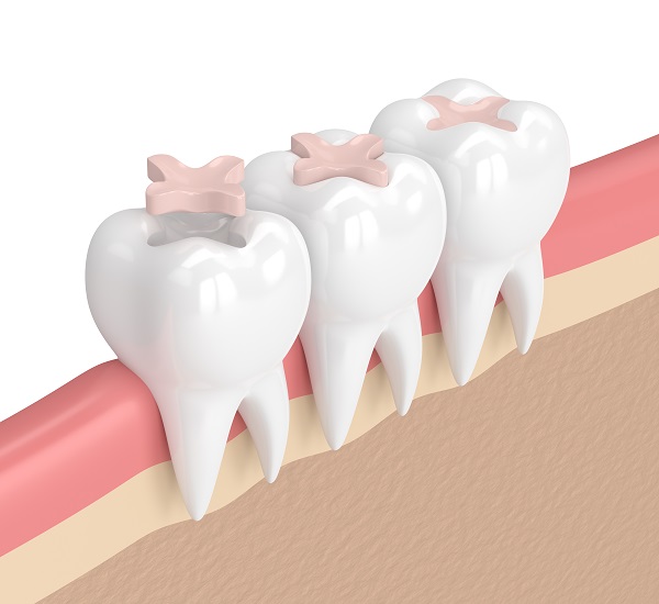 Why Is A Dental Filling Considered A Direct Dental Restoration?