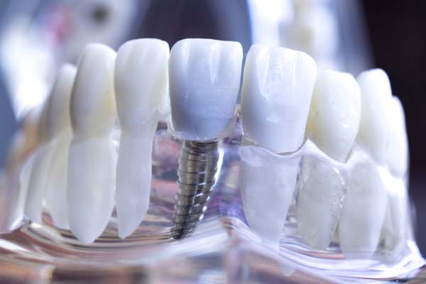 How To Protect Your Dental Implants