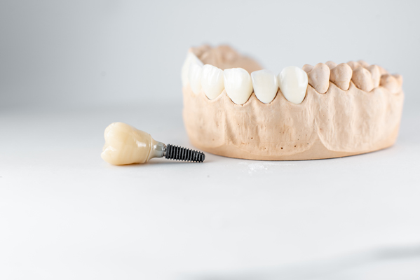 Eating And Speaking With Dental Implants