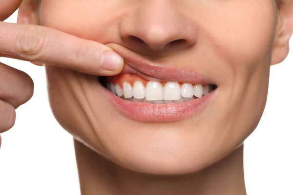 Scaling And Root Planing: Treatment For Gum Disease