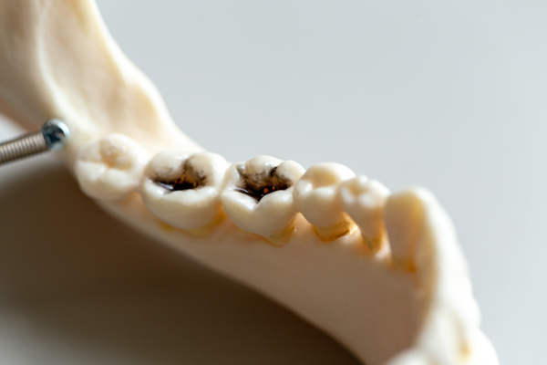 Possible Complications Of Root Canals And How To Avoid Them